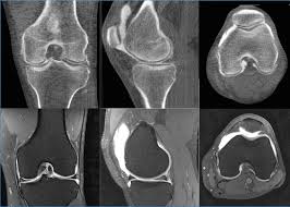 mri knee.jpg