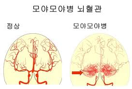 모야모야2.jpg