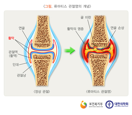 류마티스관절염.jpg