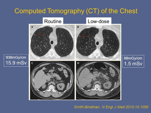 low dose CT.jpg