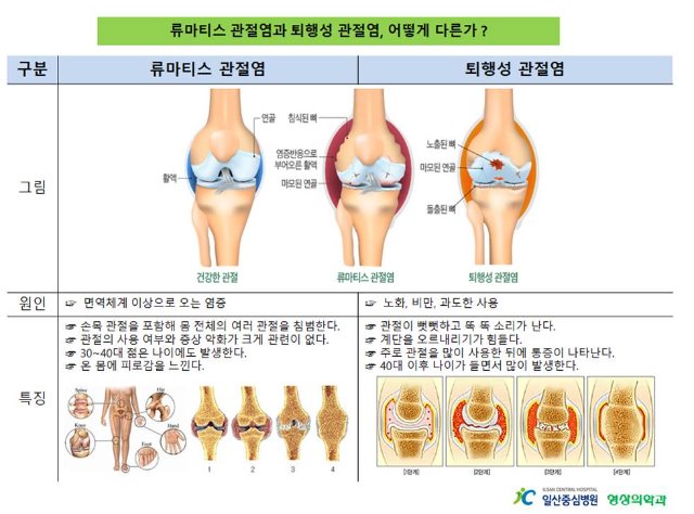 관절염.jpg