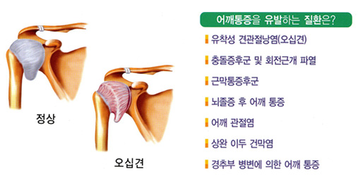오십견1.jpg