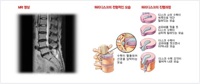 디스크.jpg