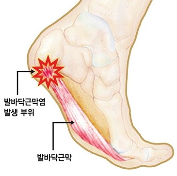 발바닥근막염.jpg
