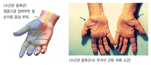수근관.jpg