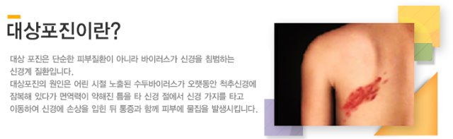 대상포진 2.jpg
