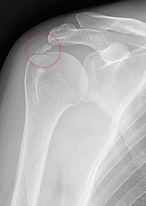 shoulder calclfication.jpg