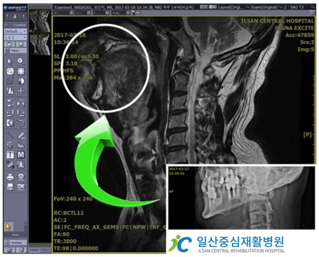 MR 임플란트.png